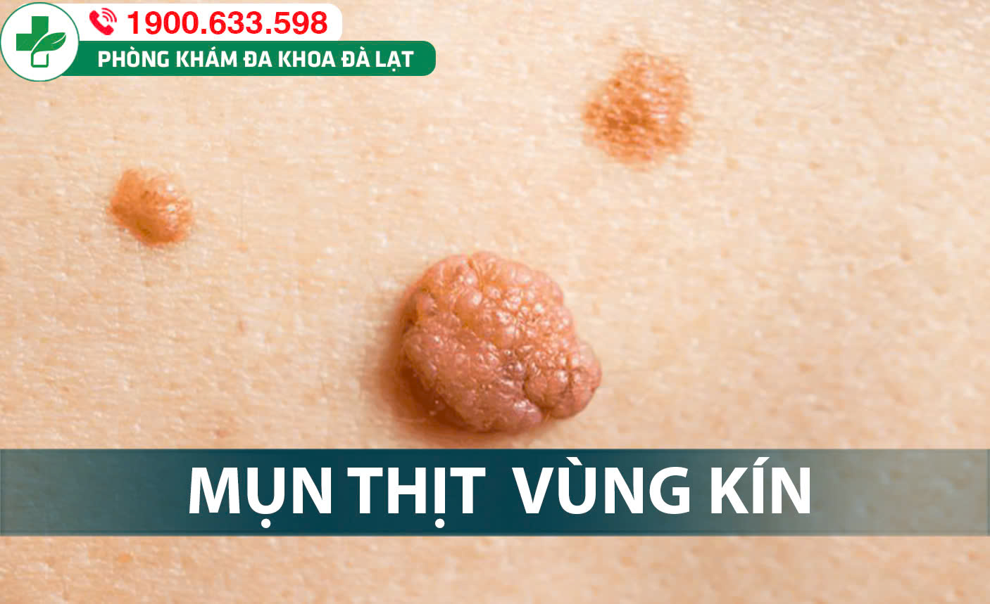 NỔI MỤN THỊT THỪA VÙNG KÍN CẢNH BÁO NGUY CƠ SÙI MÀO GÀ